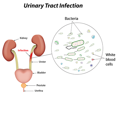 Urinary-Tract-Infection-Infographic